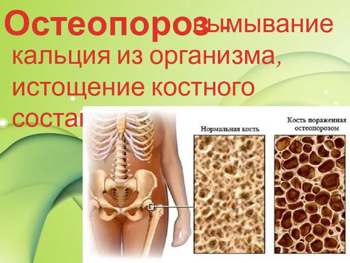Остеопороз - вымывание кальция из организма, истощение костного состава