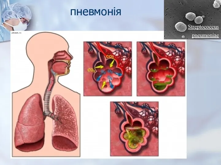 пневмонія Streptococcus pneumoniae