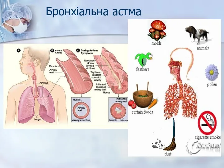 Бронхіальна астма