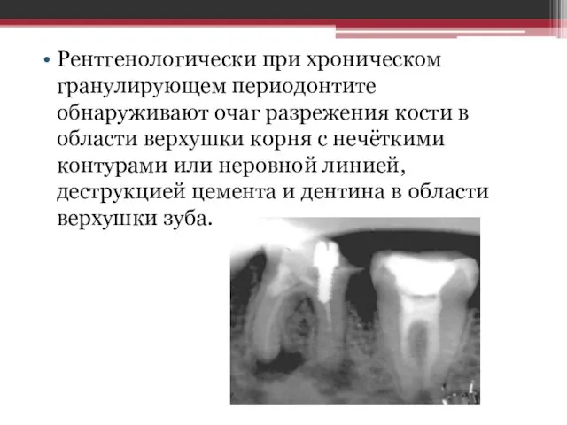 Рентгенологически при хроническом гранулирующем периодонтите обнаруживают очаг разрежения кости в области верхушки корня