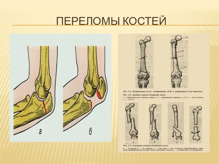 Переломы костей