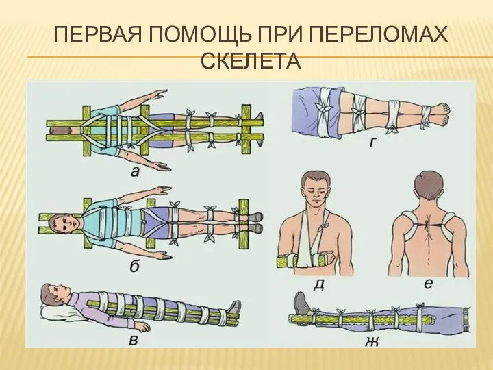 Первая помощь при переломах скелета