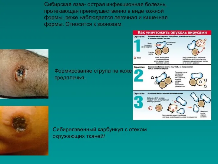 Сибиреязвенный карбункул с отеком окружающих тканей/ Формирование струпа на коже