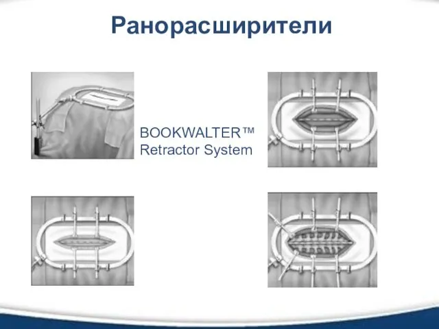Ранорасширители BOOKWALTER™ Retractor System