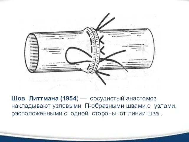 Шов Литтмана (1954) — сосудистый анастомоз накладывают узловыми П-образными швами