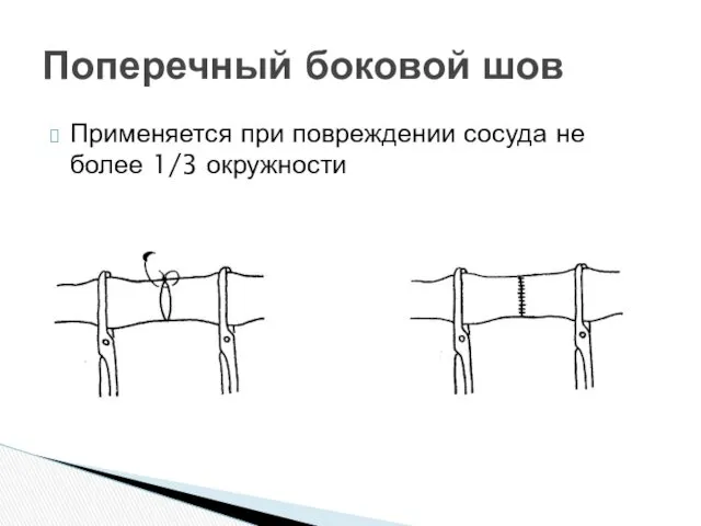 Применяется при повреждении сосуда не более 1/3 окружности Поперечный боковой шов