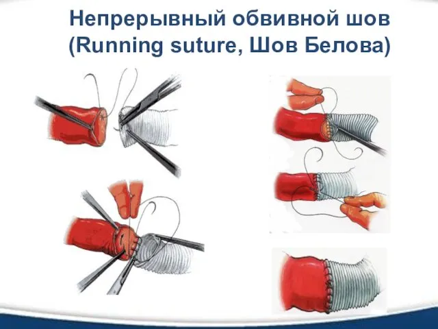 Непрерывный обвивной шов(Running suture, Шов Белова)