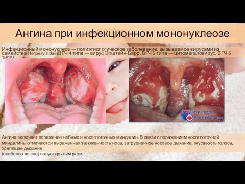 Ангина при инфекционном мононуклеозе Инфекционный мононуклеоз — полиэтиологическое заболевание, вызываемое