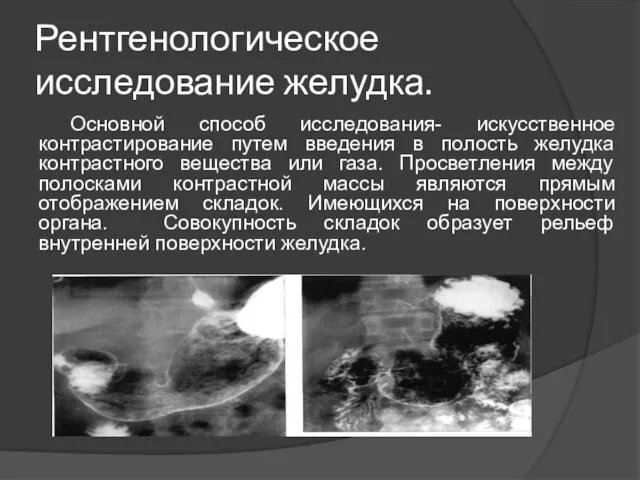 Рентгенологическое исследование желудка. Основной способ исследования- искусственное контрастирование путем введения