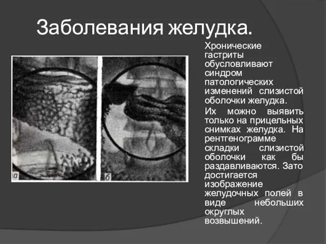 Заболевания желудка. Хронические гастриты обусловливают синдром патологических изменений слизистой оболочки