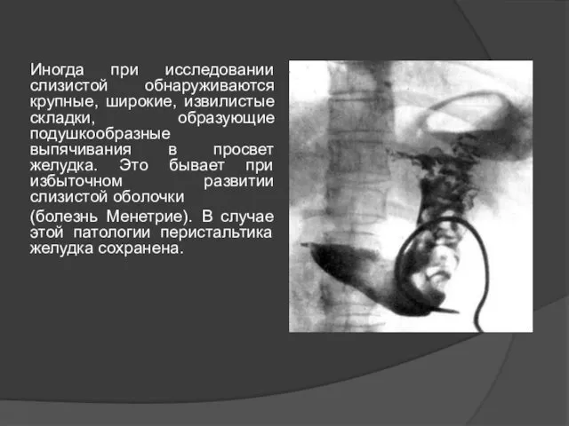 Иногда при исследовании слизистой обнаруживаются крупные, широкие, извилистые складки, образующие