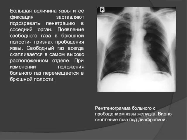 Большая величина язвы и ее фиксация заставляют подозревать пенетрацию в