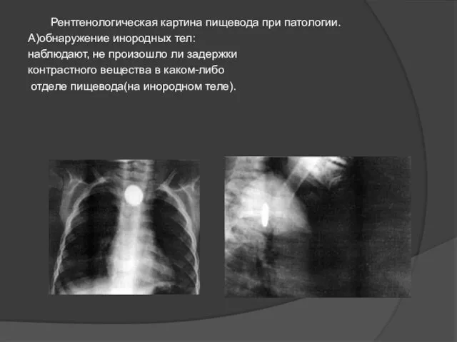 Рентгенологическая картина пищевода при патологии. А)обнаружение инородных тел: наблюдают, не