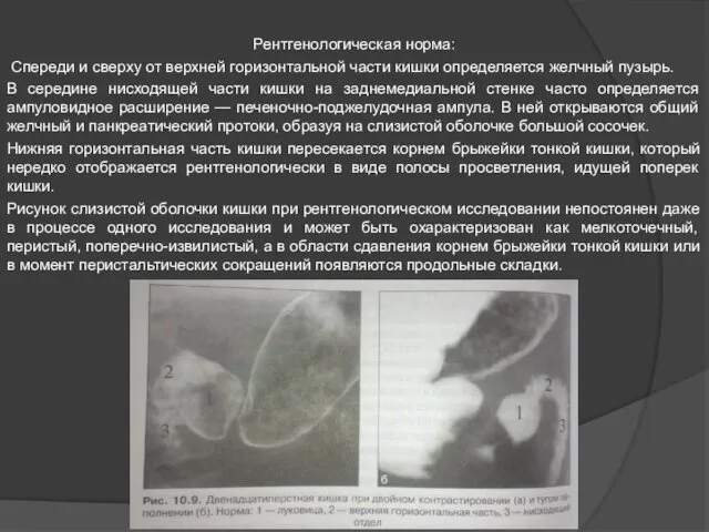 Рентгенологическая норма: Спереди и сверху от верхней горизонтальной части кишки