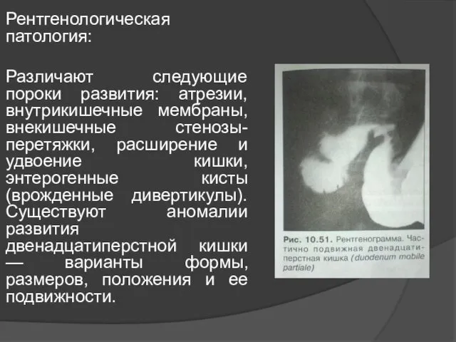 Рентгенологическая патология: Различают следующие пороки развития: атрезии, внутрикишечные мембраны, внекишечные