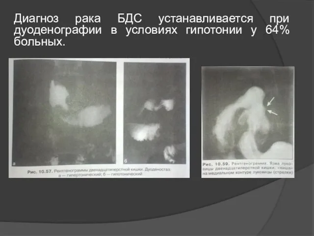 Диагноз рака БДС устанавливается при дуоденографии в условиях гипотонии у 64% больных.