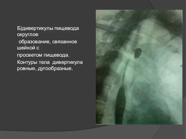 Б)дивертикулы пищевода округлое образование, связанное шейкой с просветом пищевода. Контуры тела дивертикула ровные, дугообразные.