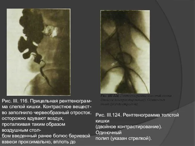 Рис. III. 116. Прицельная рентгенограм- ма слепой кишки. Контрастное вещест-