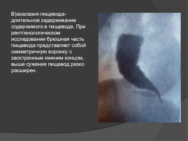 В)ахалазия пищевода- длительное задерживание содержимого в пищеводе. При рентгенологическом исследовании