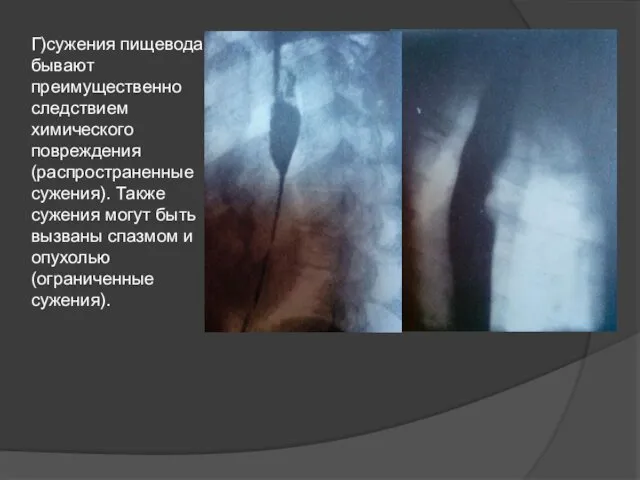 Г)сужения пищевода бывают преимущественно следствием химического повреждения(распространенные сужения). Также сужения