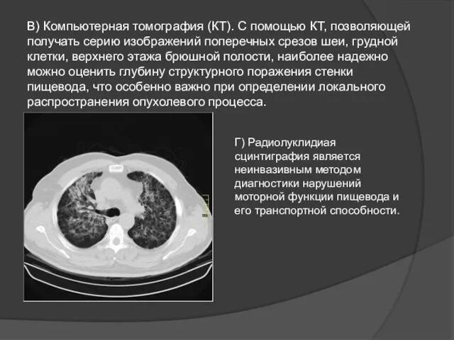 В) Компьютерная томография (КТ). С помощью КТ, позволяющей получать серию