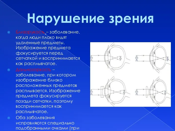 Близорукость – заболевание, когда люди плохо видят удаленные предметы. Изображение