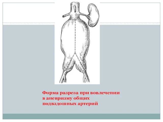 Форма разреза при вовлечении в аневризму общих подвздошных артерий
