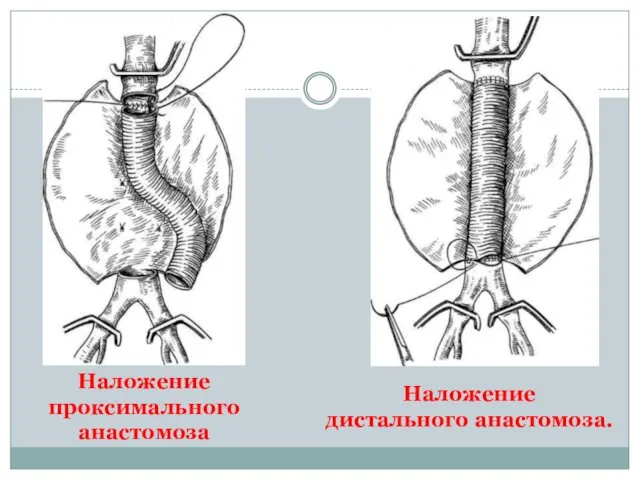 Наложение проксимального анастомоза Наложение дистального анастомоза.