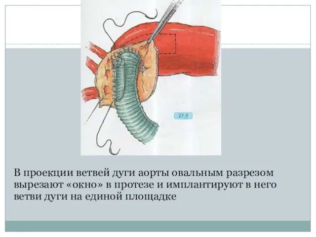 В проекции ветвей дуги аорты овальным разрезом вырезают «окно» в