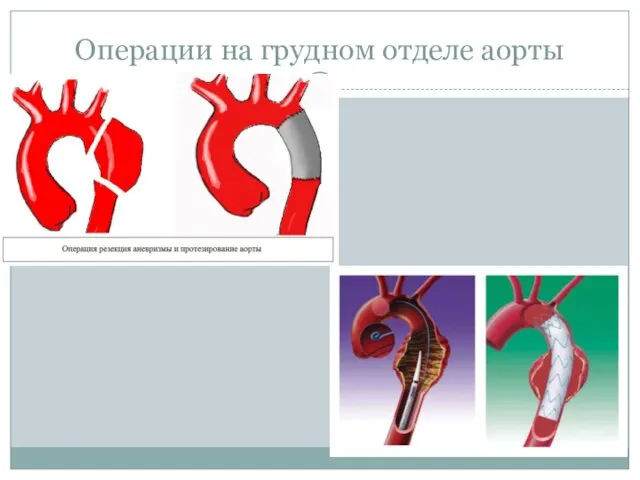 Операции на грудном отделе аорты