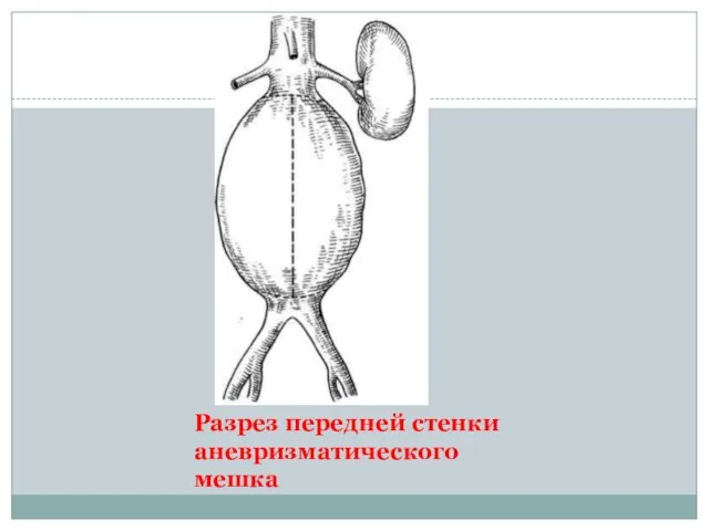 Разрез передней стенки аневризматического мешка