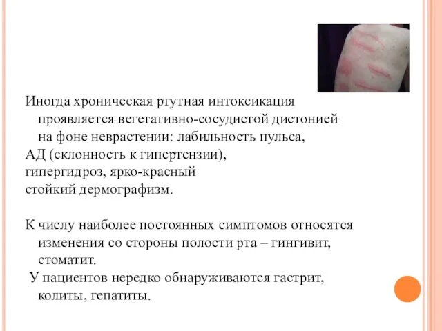 Иногда хроническая ртутная интоксикация проявляется вегетативно-сосудистой дистонией на фоне неврастении: