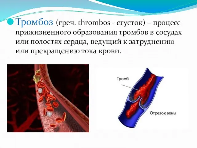 Тромбоз (греч. thrombos - сгусток) – процесс прижизненного образования тромбов