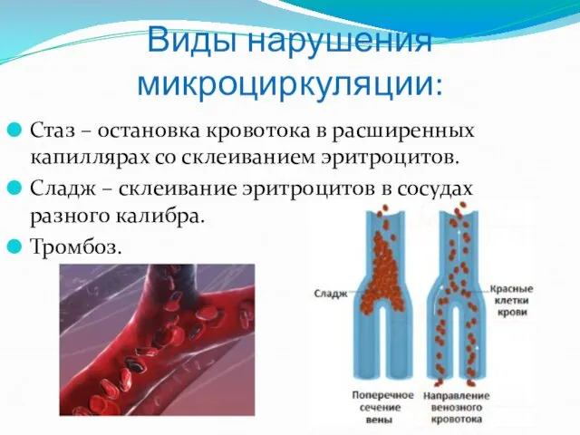 Виды нарушения микроциркуляции: Стаз – остановка кровотока в расширенных капиллярах