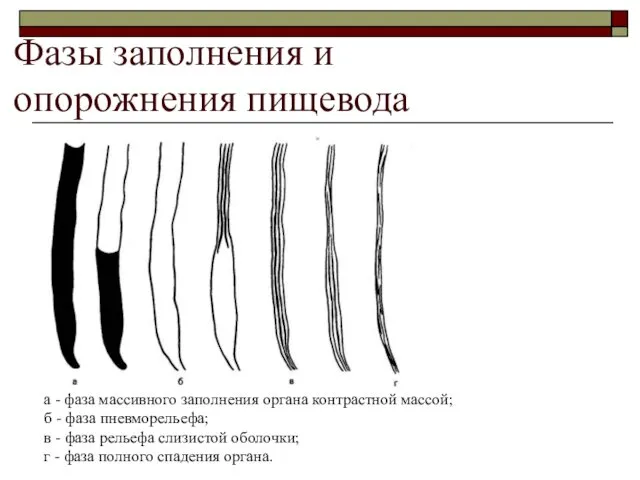 Фазы заполнения и опорожнения пищевода а - фаза массивного заполнения