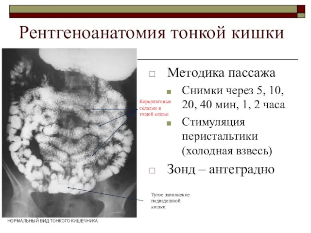 Рентгеноанатомия тонкой кишки Методика пассажа Снимки через 5, 10, 20,