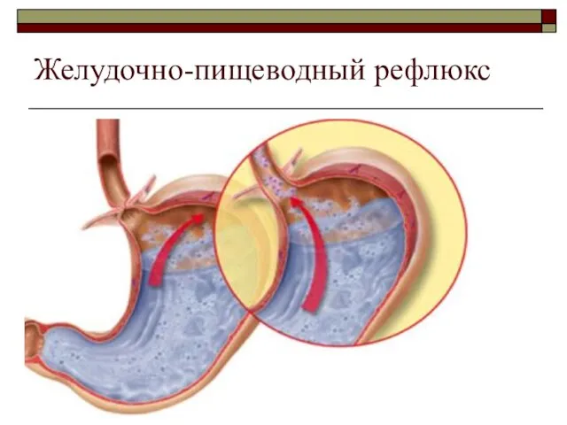 Желудочно-пищеводный рефлюкс