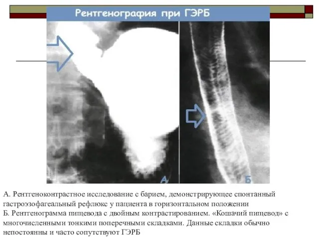 А. Рентгеноконтрастное исследование с барием, демонстрирующее спонтанный гастроэзофагеальный рефлюкс у