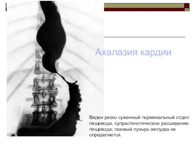 Виден резко суженный терминальный отдел пищевода, супрастенотическое расширение пищевода; газовый пузырь желудка не определяется. Ахалазия кардии