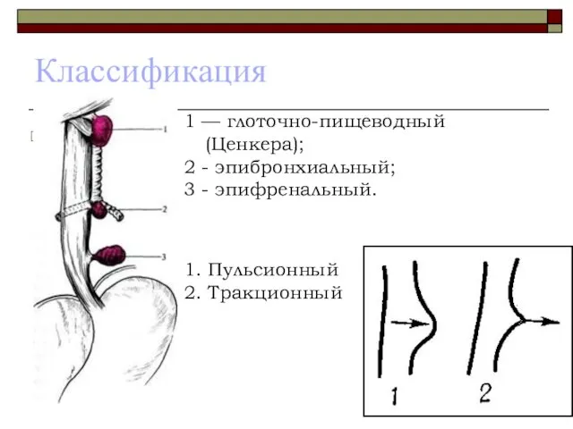 Классификация 1 — глоточно-пищеводный (Ценкера); 2 - эпибронхиальный; 3 - эпифренальный. 1. Пульсионный 2. Тракционный