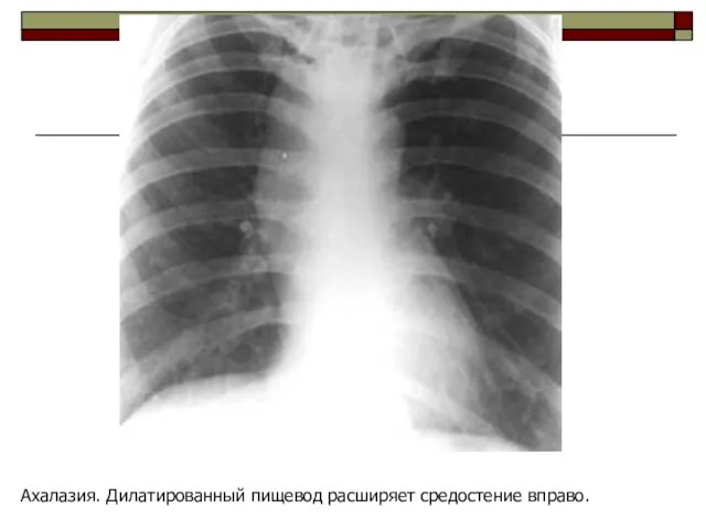 Ахалазия. Дилатированный пищевод расширяет средостение вправо.