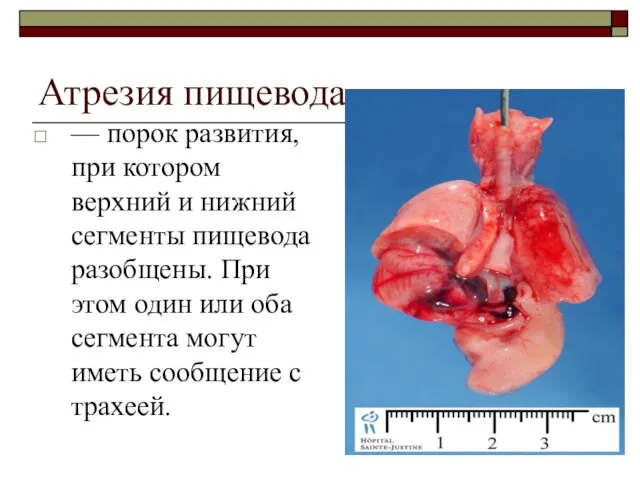 Атрезия пищевода — порок развития, при котором верхний и нижний