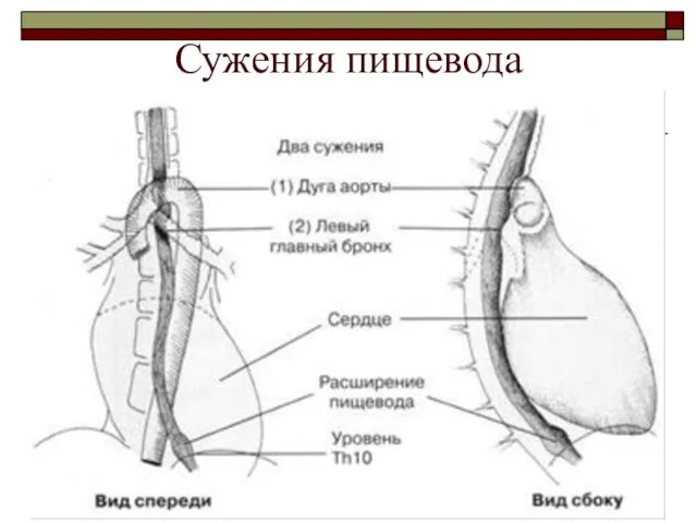 Сужения пищевода