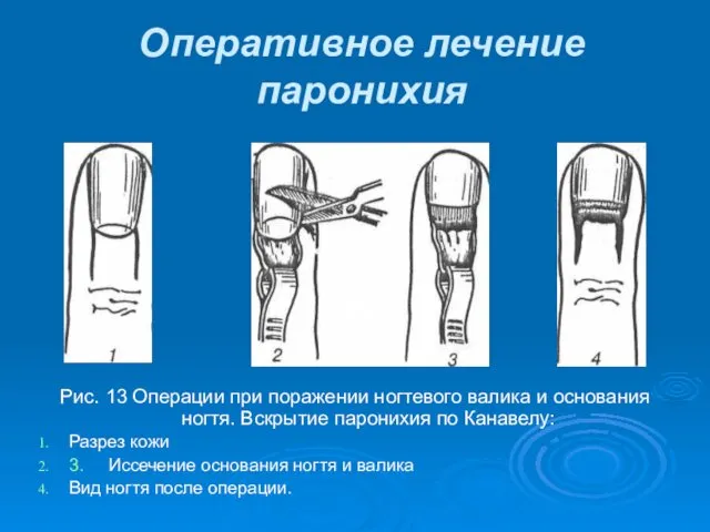 Рис. 13 Операции при поражении ногтевого валика и основания ногтя.