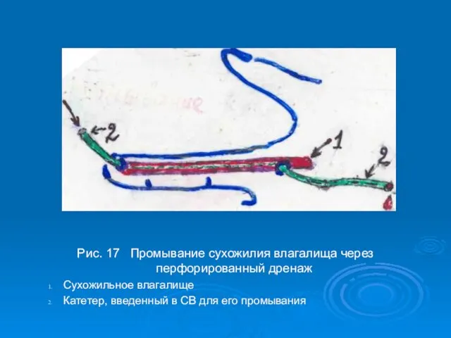 Рис. 17 Промывание сухожилия влагалища через перфорированный дренаж Сухожильное влагалище