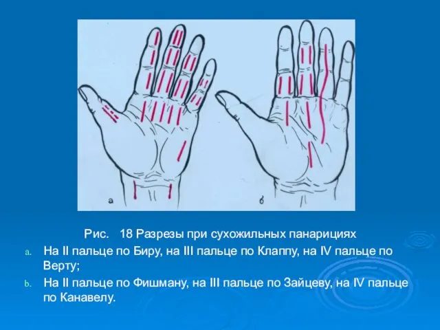 Рис. 18 Разрезы при сухожильных панарициях На II пальце по