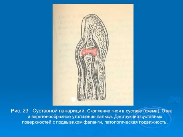 Рис. 23 Суставной панариций. Скопление гноя в суставе (схема). Отек