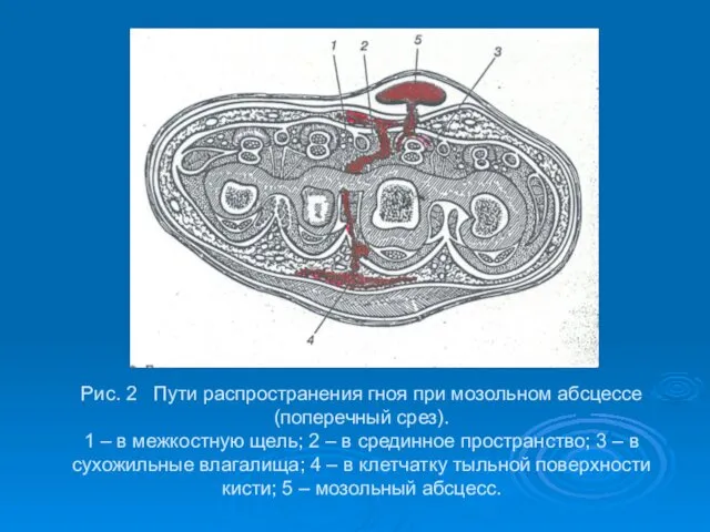 Рис. 2 Пути распространения гноя при мозольном абсцессе (поперечный срез).