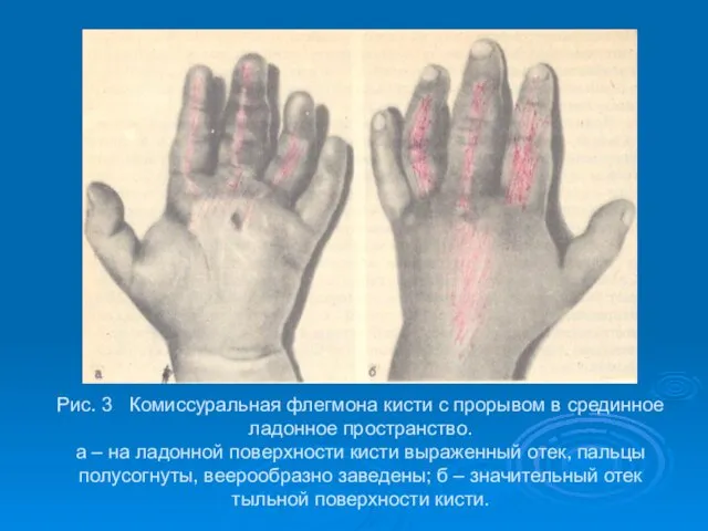 Рис. 3 Комиссуральная флегмона кисти с прорывом в срединное ладонное