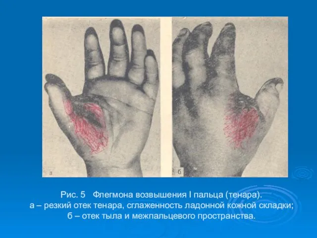 Рис. 5 Флегмона возвышения I пальца (тенара). а – резкий